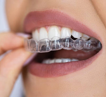 Close-up of person placing a clear dental night guard over their teeth